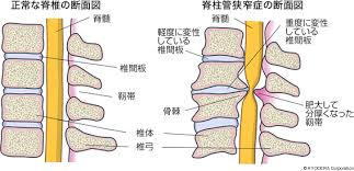 脊椎管狭窄症による痛み